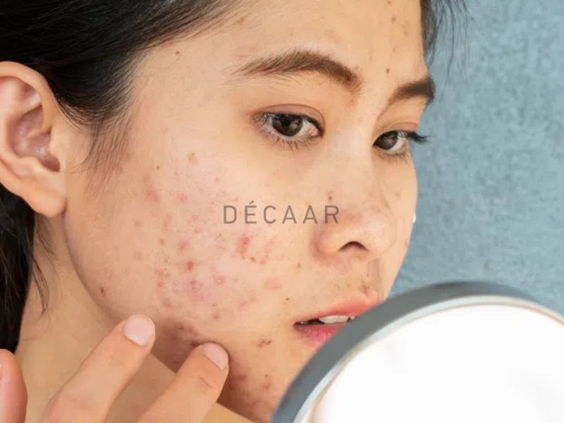Chăm sóc da khoa học giúp kiểm soát mụn hiệu quả